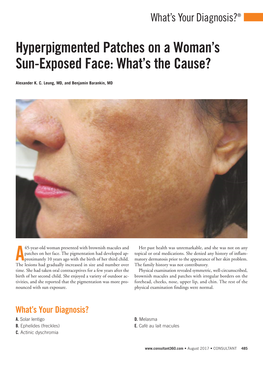 Hyperpigmented Patches on a Woman's Sun-Exposed Face