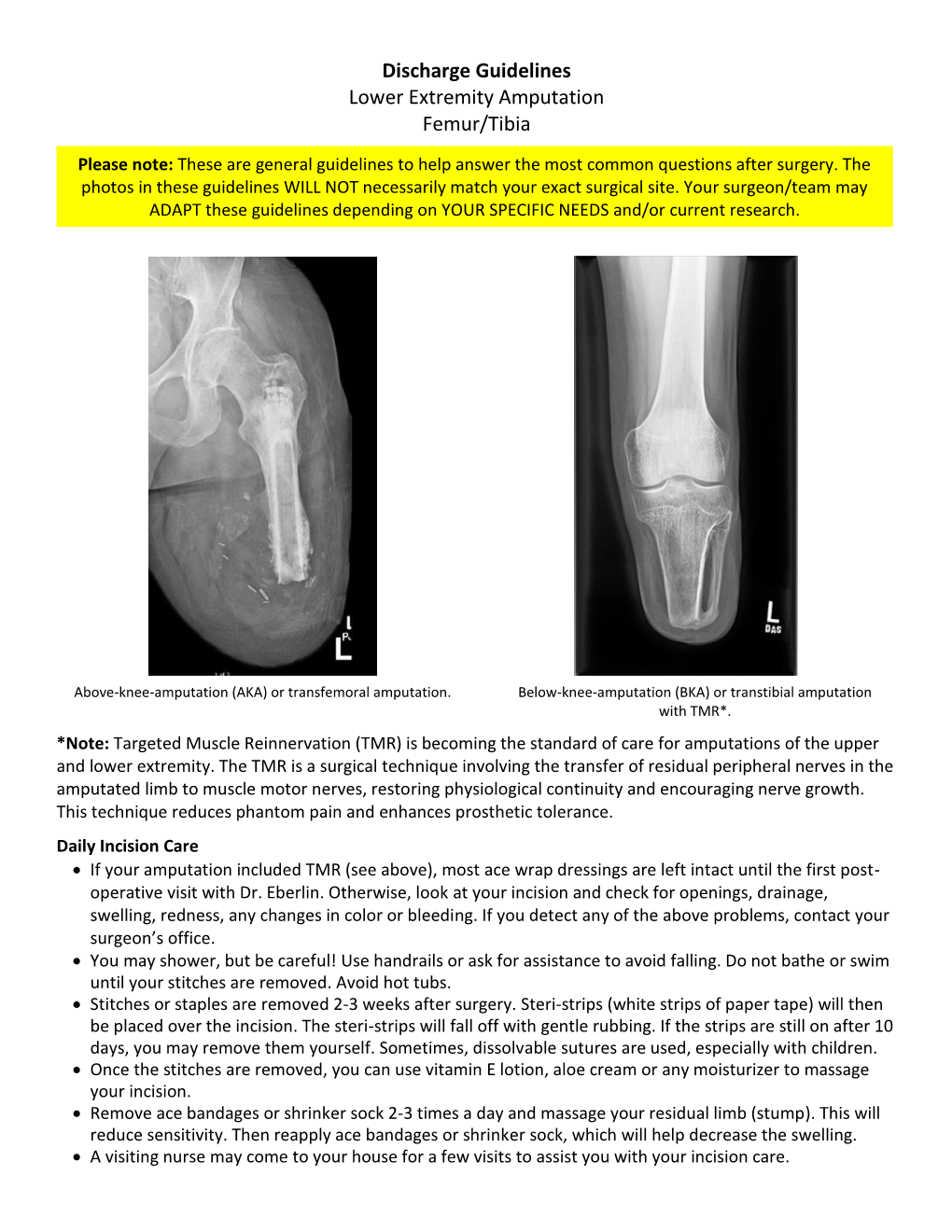 Discharge Guidelines Lower Extremity Amputation Femur/Tibia - DocsLib