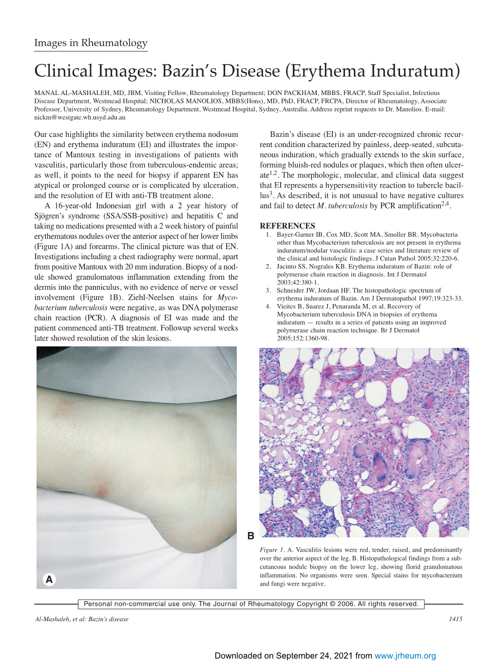 Bazin's Disease (Erythema Induratum)