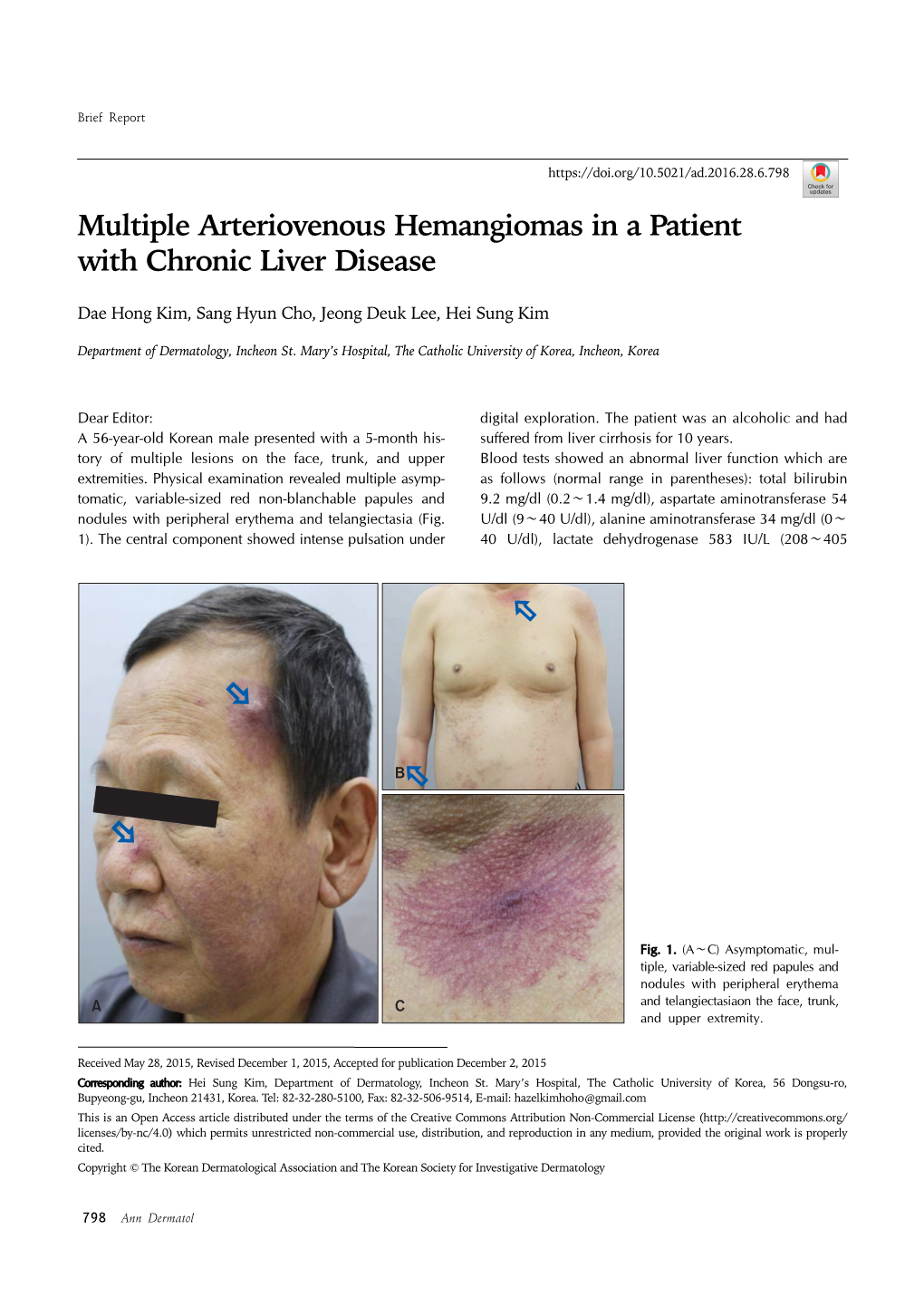 Multiple Arteriovenous Hemangiomas in a Patient with Chronic Liver Disease
