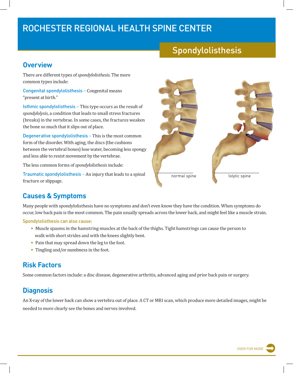 ROCHESTER REGIONAL HEALTH SPINE CENTER Spondylolisthesis