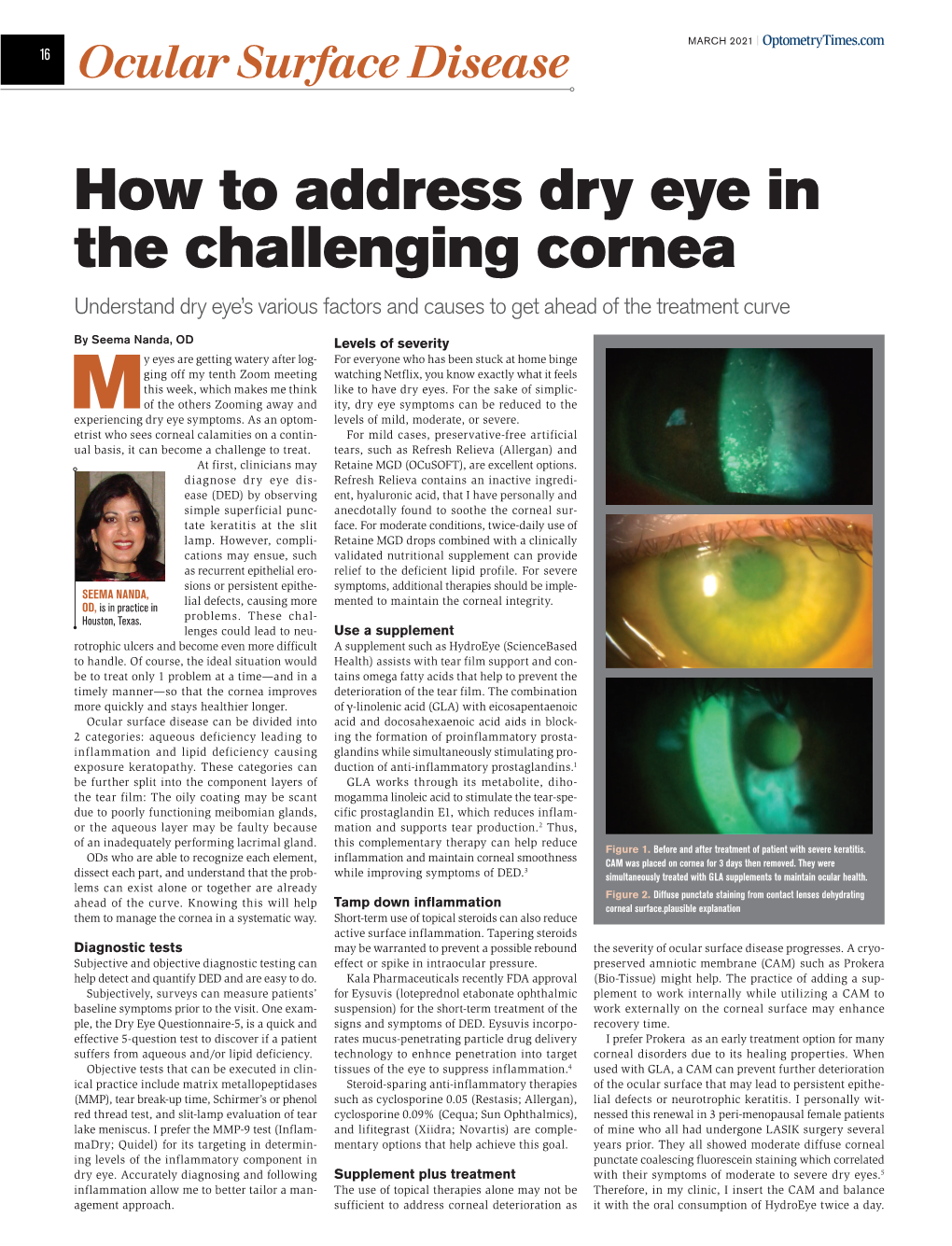 How to Address Dry Eye in the Challenging Cornea Understand Dry Eye’S Various Factors and Causes to Get Ahead of the Treatment Curve
