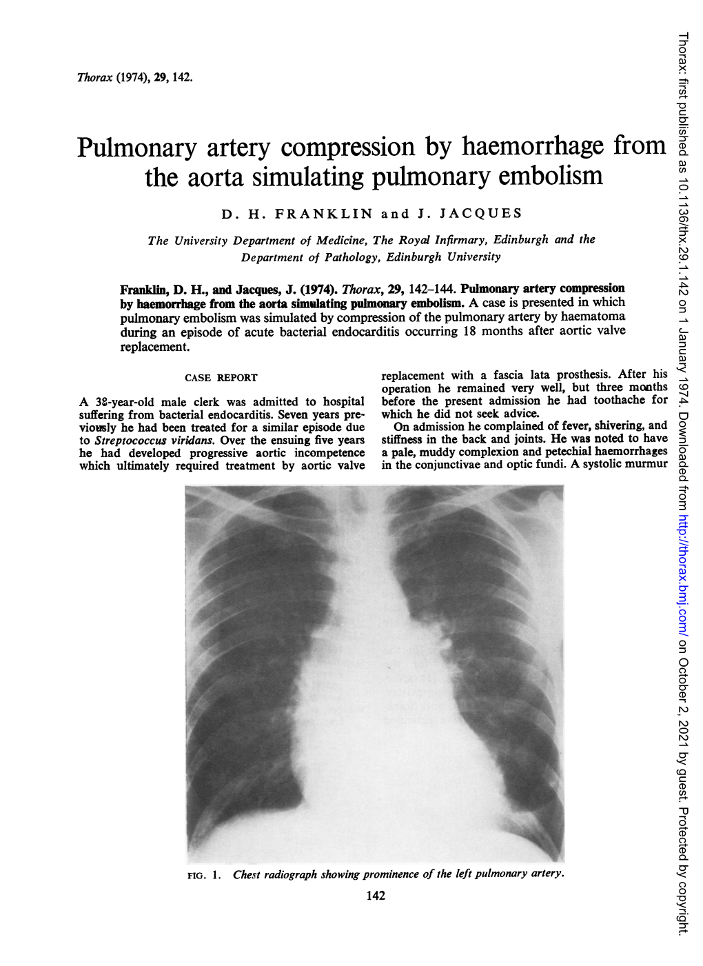 The Aorta Simulating Pulmonary Embolism D