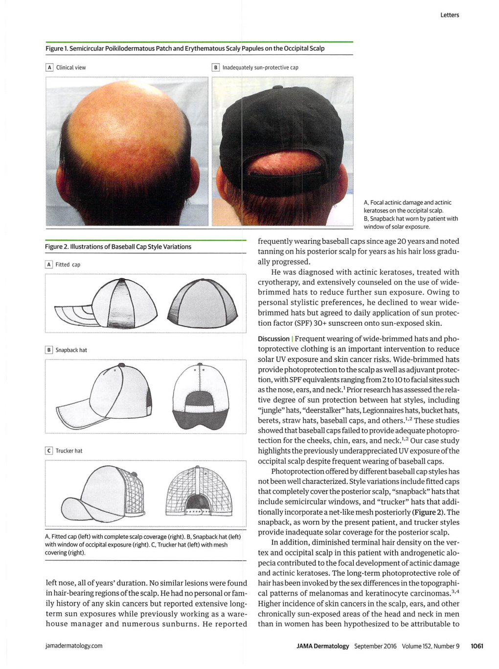 Trucker Hat Highlights the Previouslyunderappreciated Uvexposure of the Occipital Scalp Despite Frequent Wearing Ofbaseball Caps