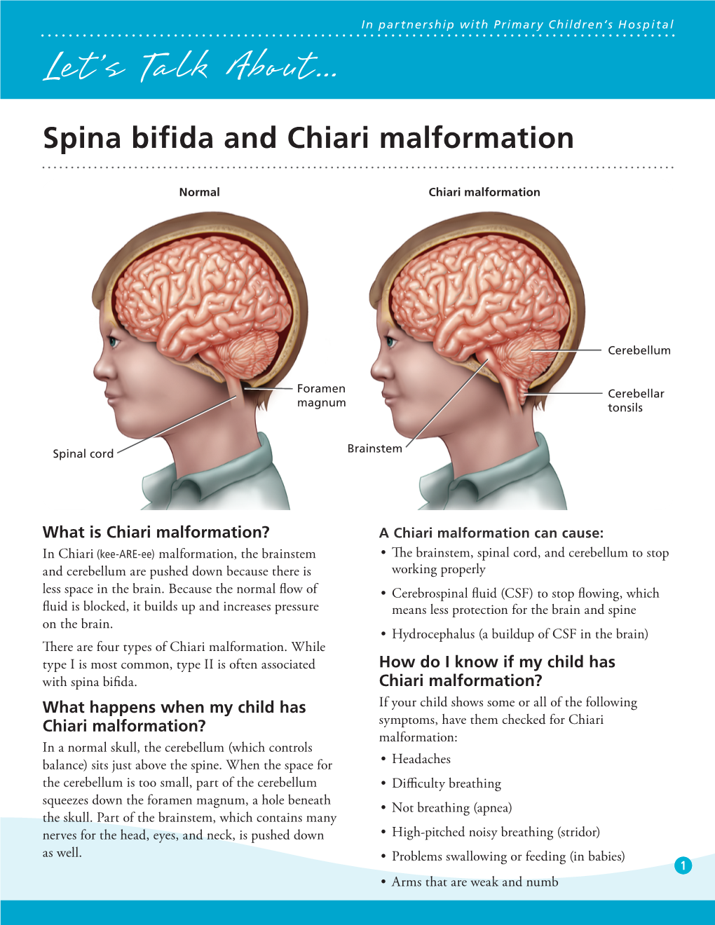 Spina Bifida and Chiari Malformation