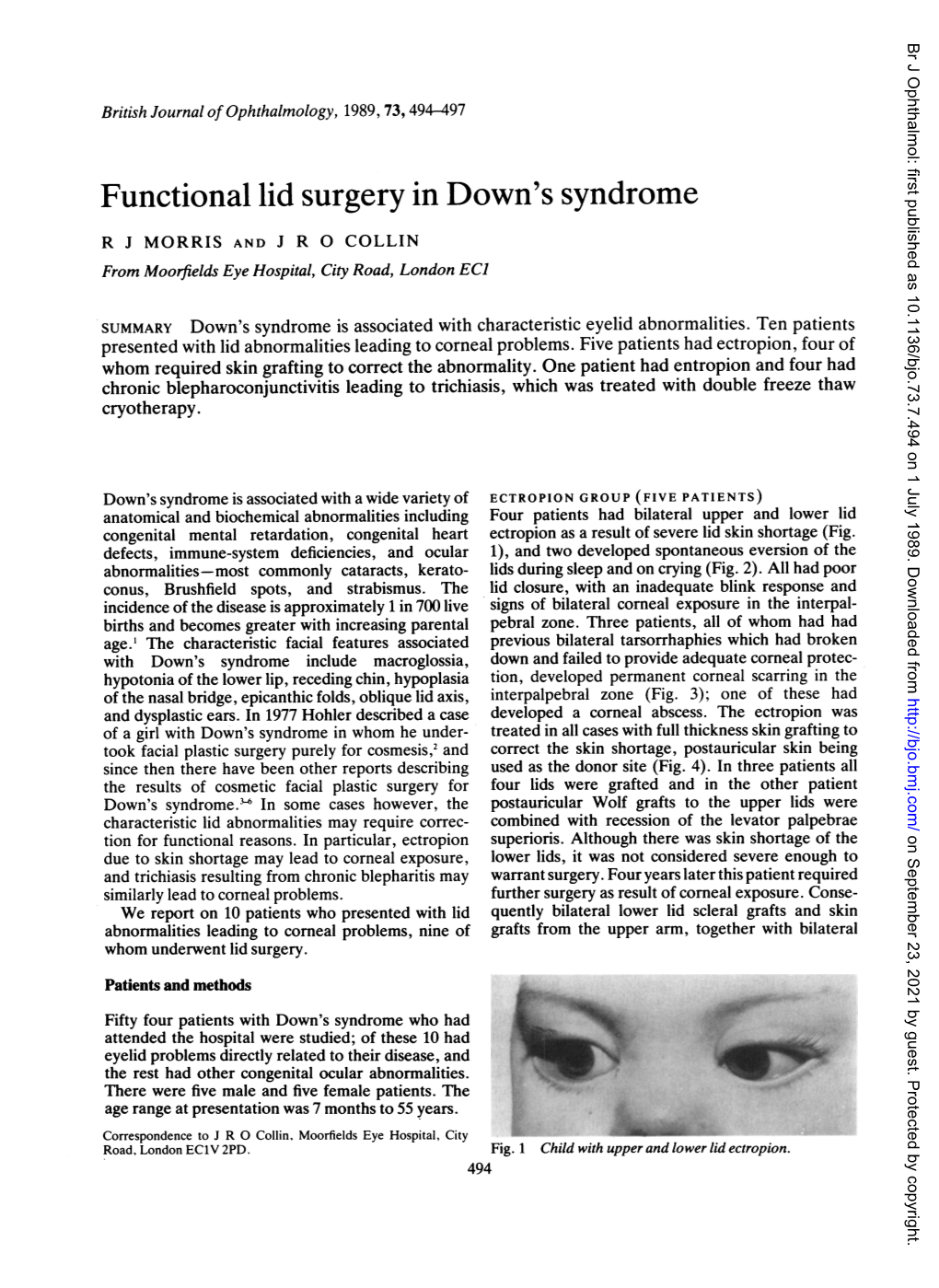 Functional Lid Surgery in Down's Syndrome