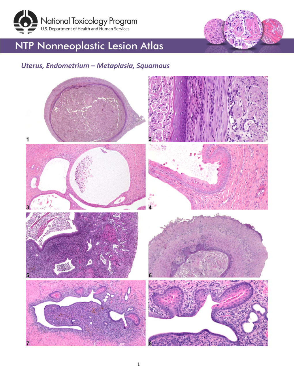 Uterus, Endometrium – Metaplasia, Squamous - DocsLib