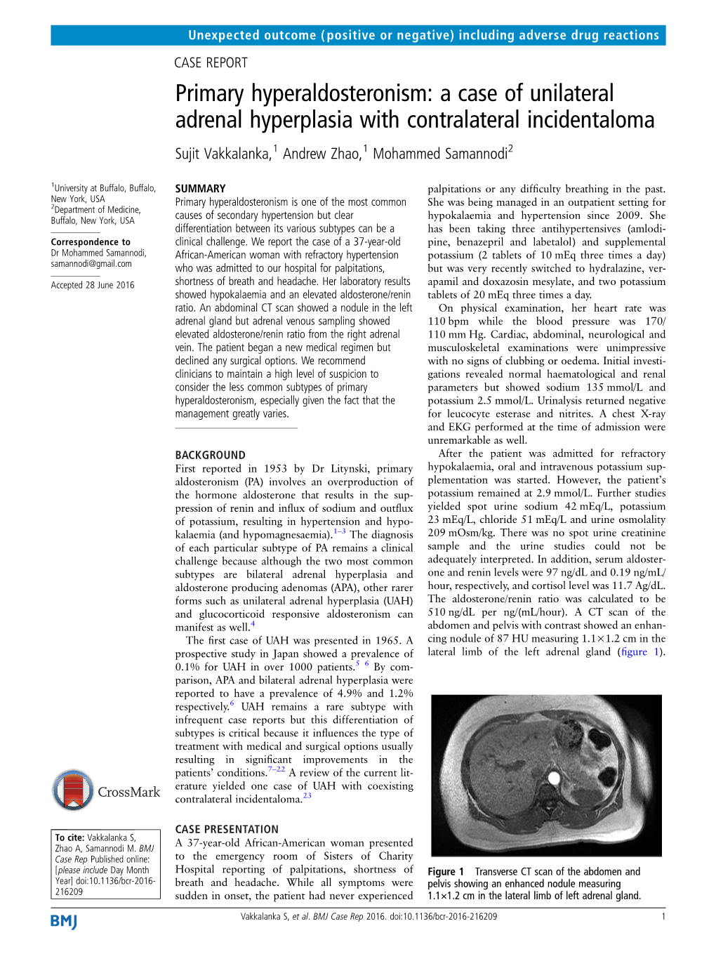 Primary Hyperaldosteronism: a Case of Unilateral Adrenal Hyperplasia with Contralateral Incidentaloma Sujit Vakkalanka,1 Andrew Zhao,1 Mohammed Samannodi2