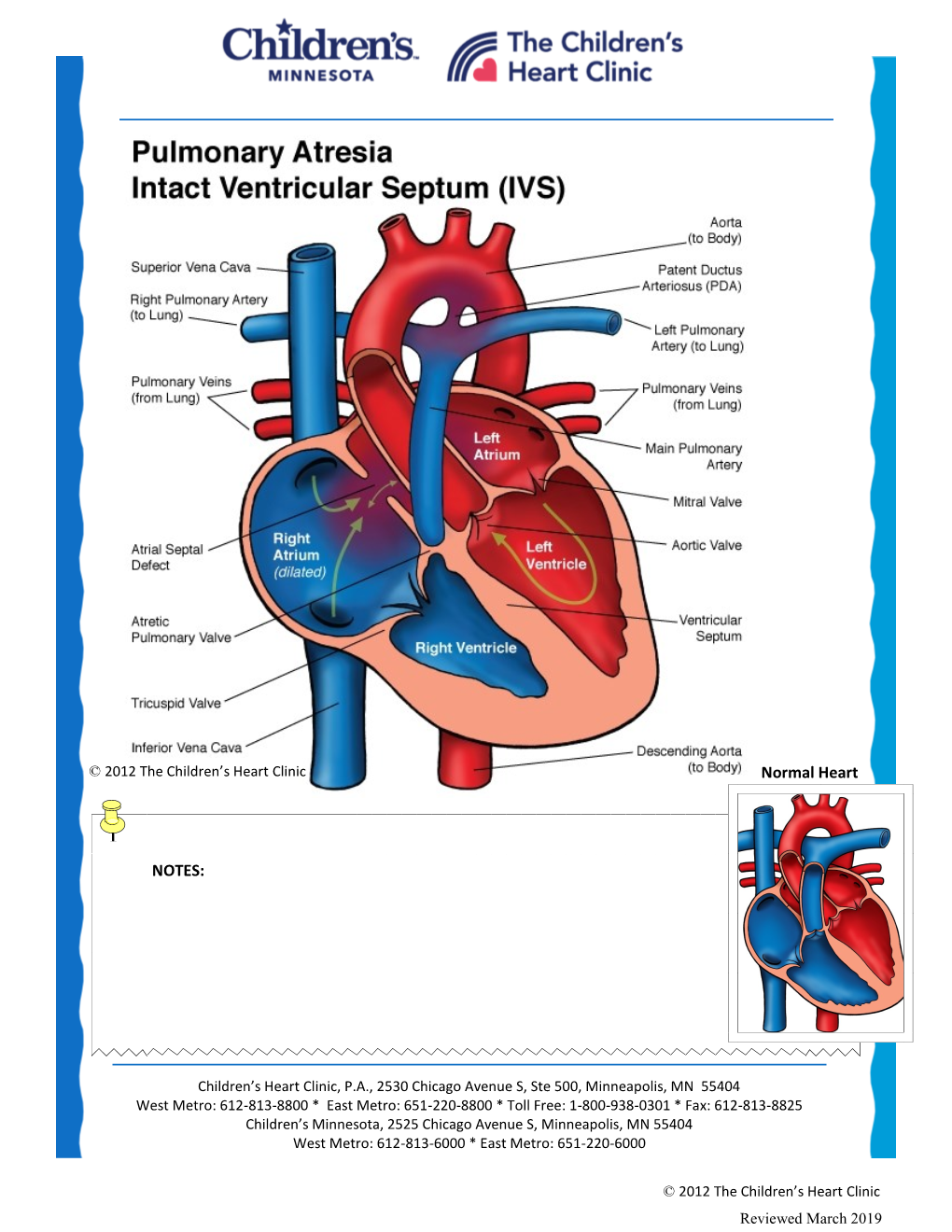 Pulmonary Atresia: Intact Ventricular Septum