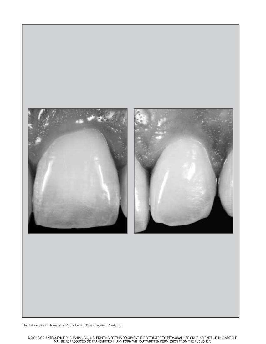 Papilla Proportions in the Maxillary Anterior Dentition