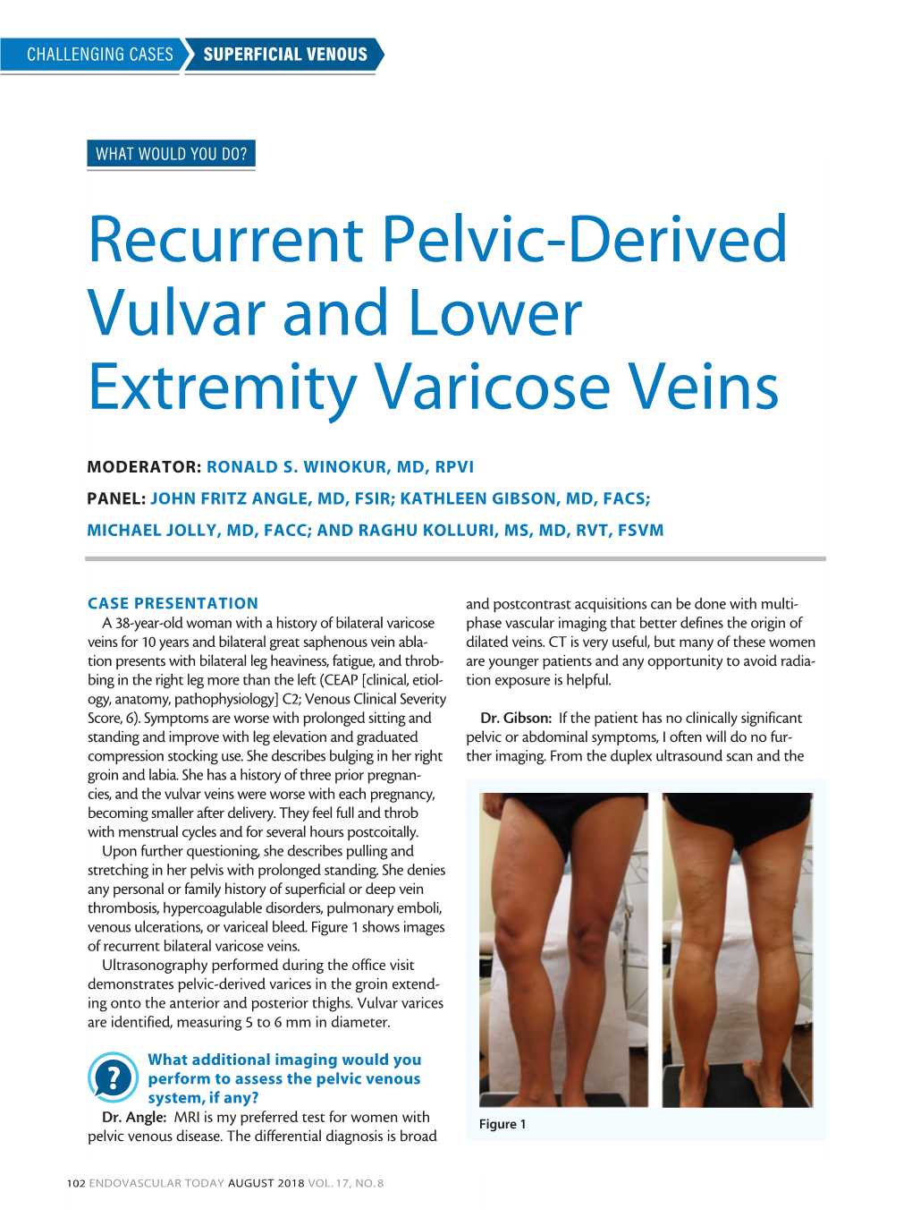 recurrent-pelvic-derived-vulvar-and-lower-extremity-varicose-veins