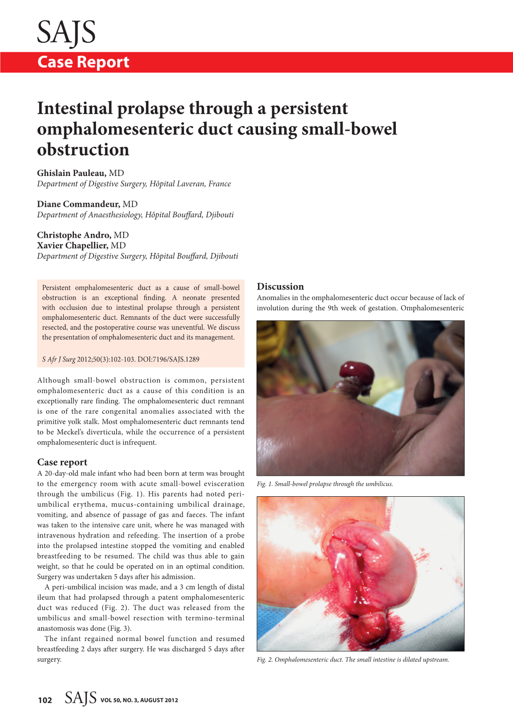 Intestinal Prolapse Through a Persistent Omphalomesenteric Duct