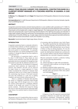 Single Stage Release Surgery for Congenital Constriction Band in a Clubfoot Patient Managed at a Teaching Hospital in Uganda: a Case Report G