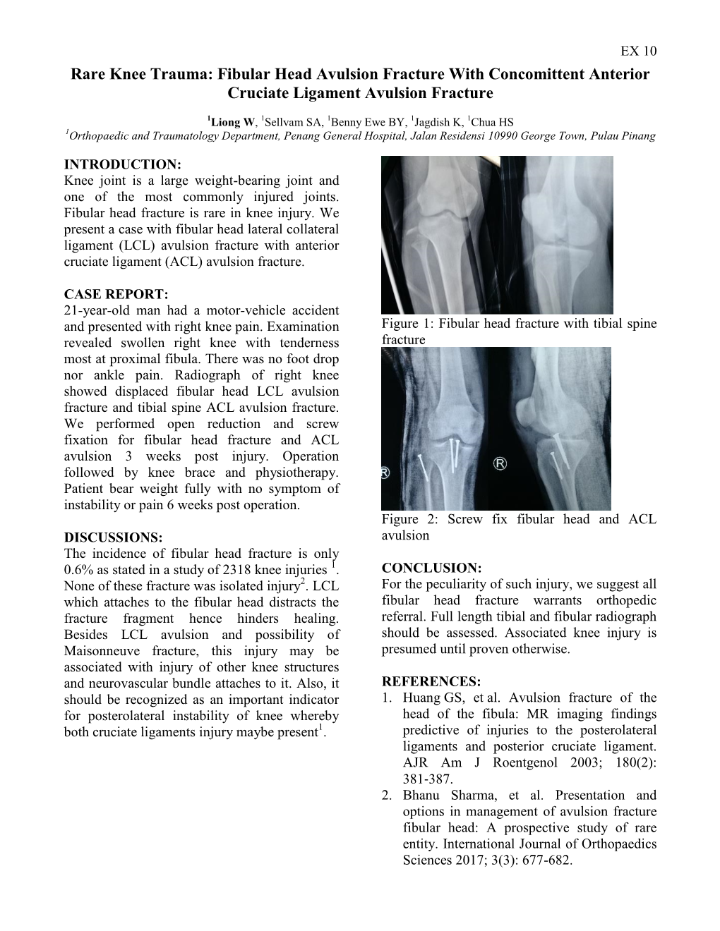 Fibular Head Avulsion Fracture with Anterior Cruciate