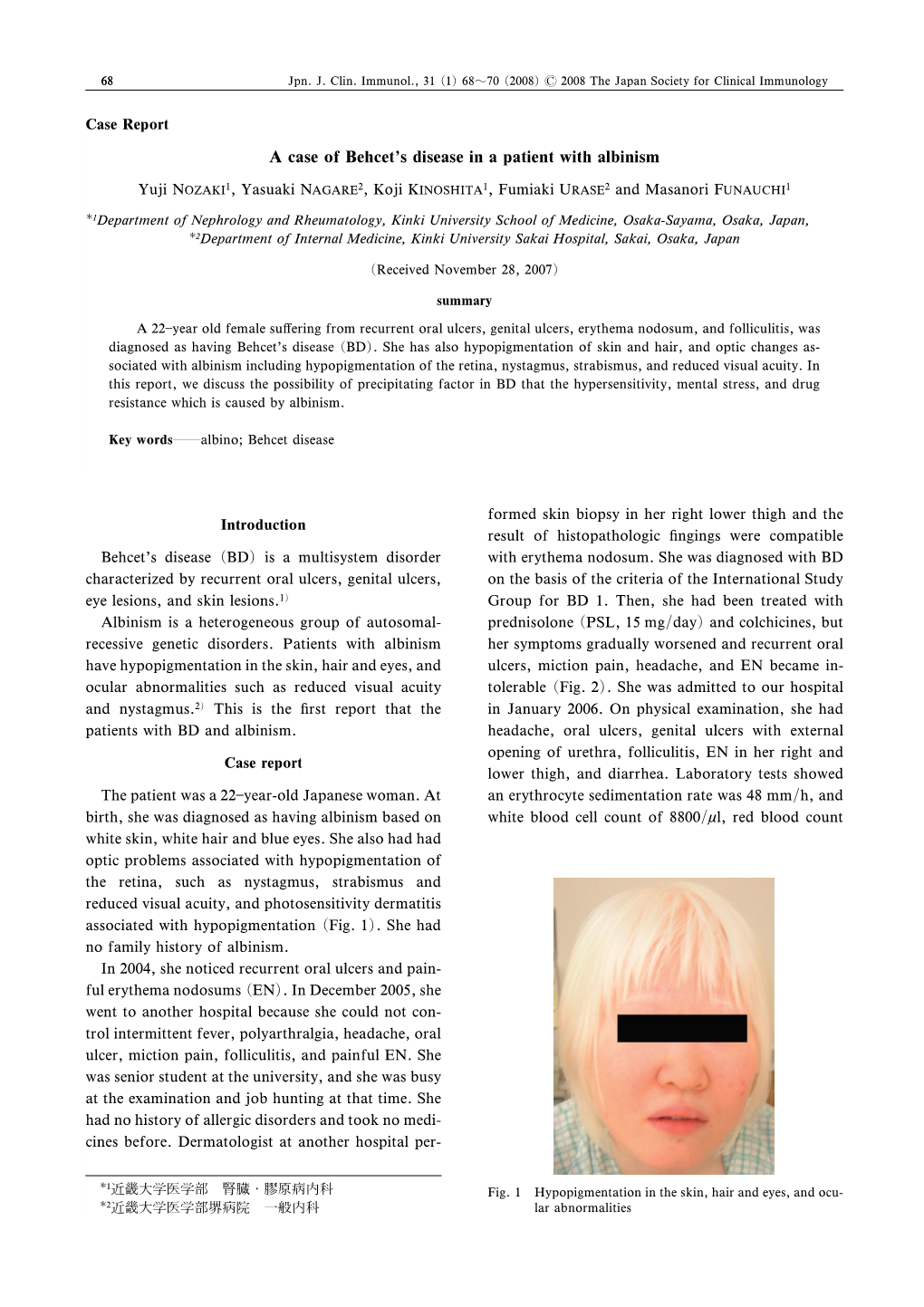 A Case of Behcet's Disease in a Patient with Albinism