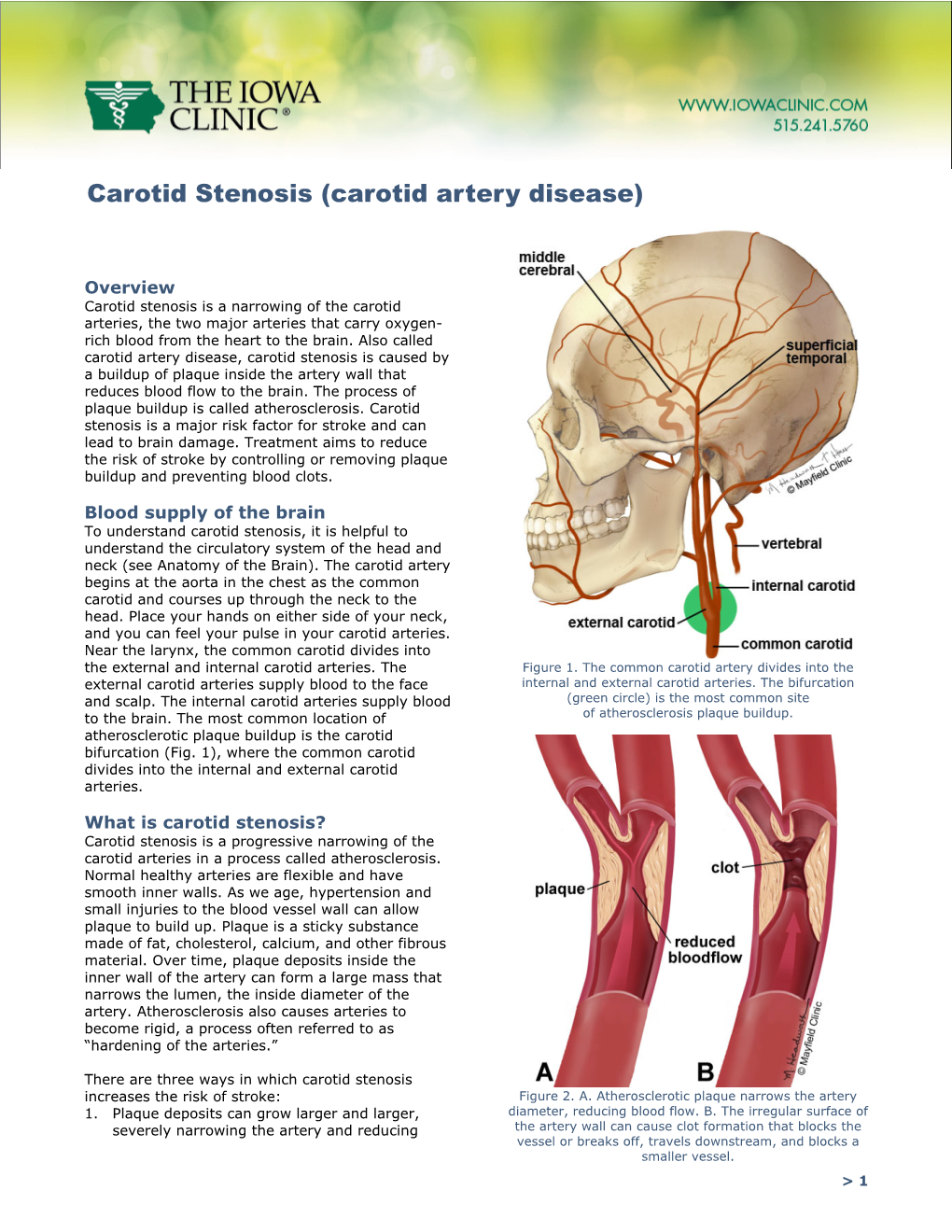 Carotid Stenosis (Carotid Artery Disease)
