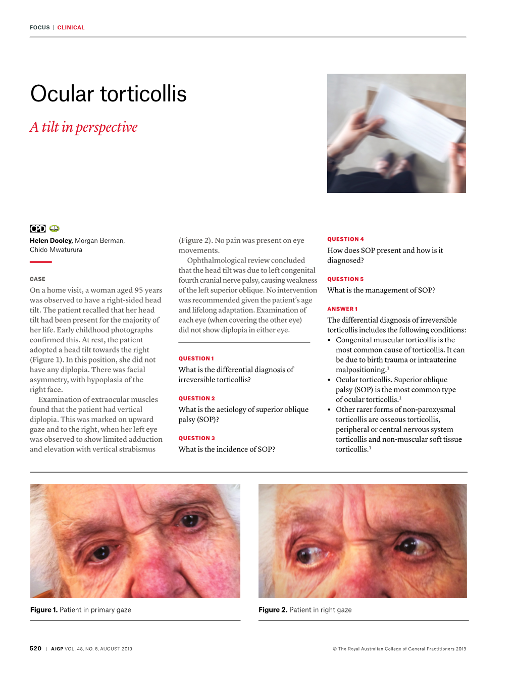 Ocular Torticollis