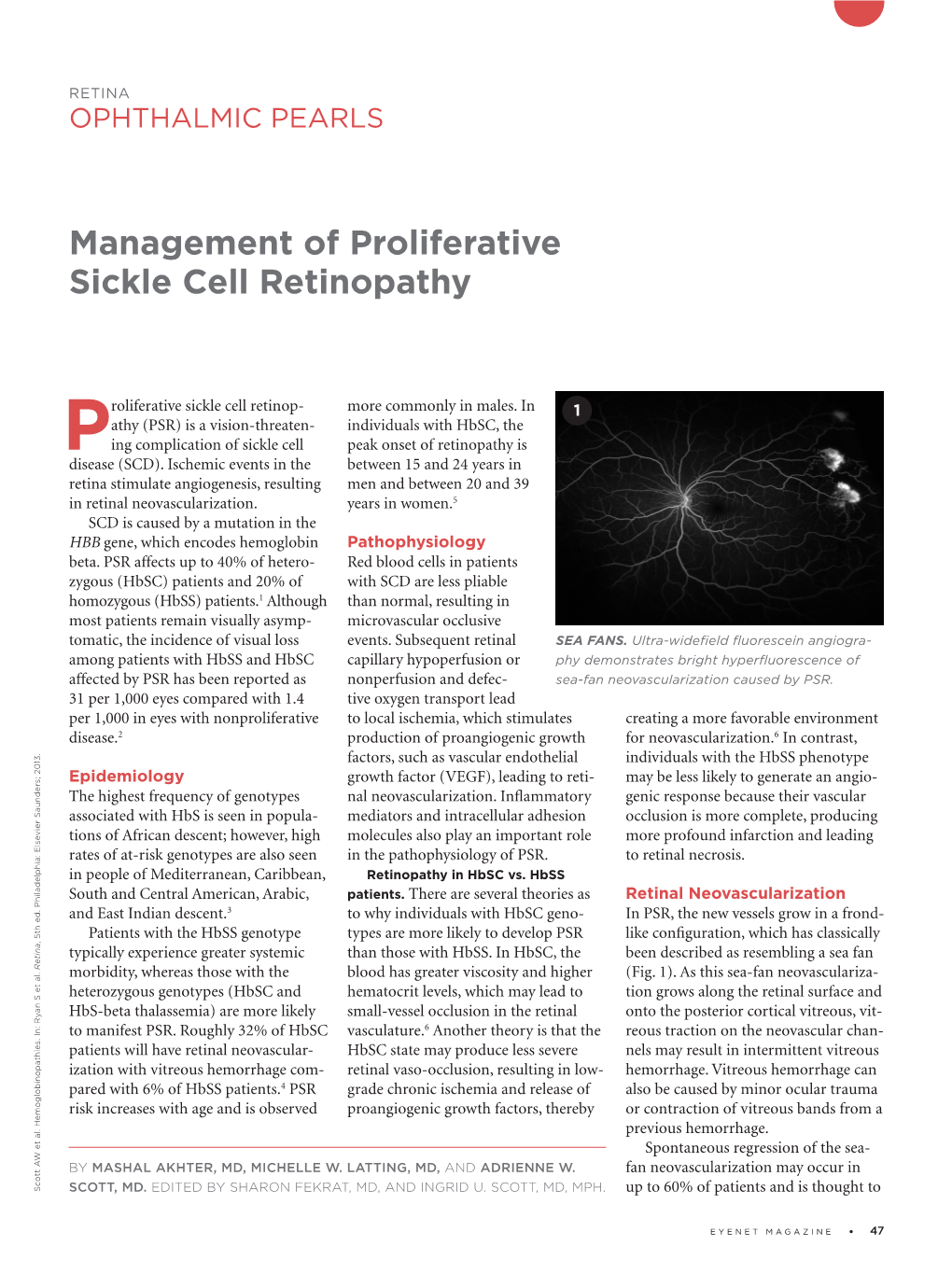 Management of Proliferative Sickle Cell Retinopathy