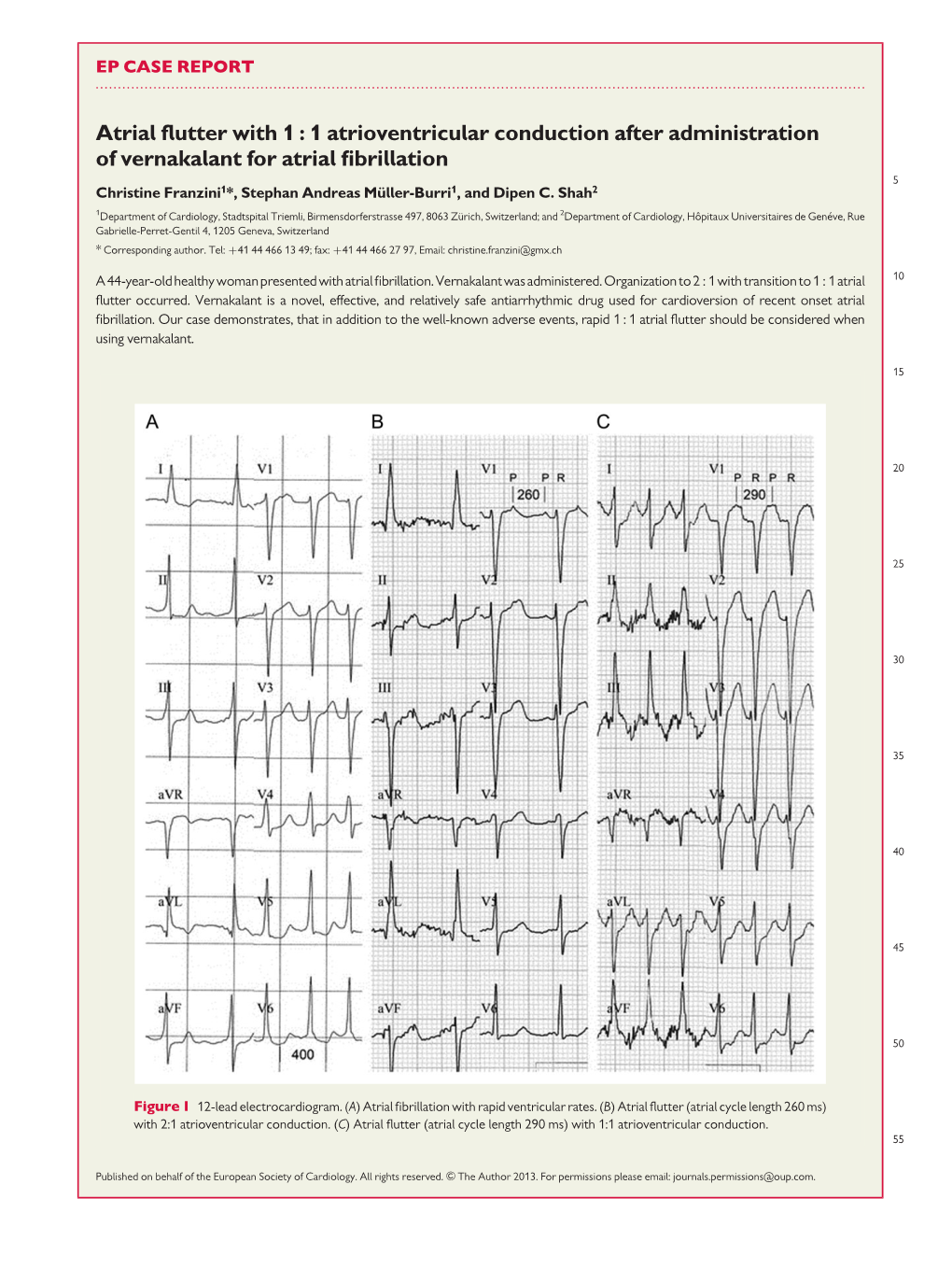Atrial Flutter with 1 : 1 Atrioventricular Conduction After Administration Of