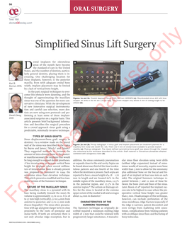 Simplified Sinus Lift Surgery