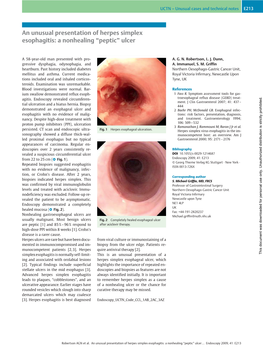 An Unusual Presentation of Herpes Simplex Esophagitis: a Nonhealing “Peptic” Ulcer