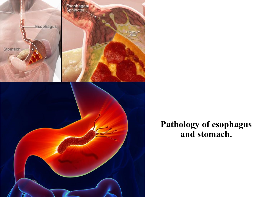 4. Pathology Esophagus and Stomach