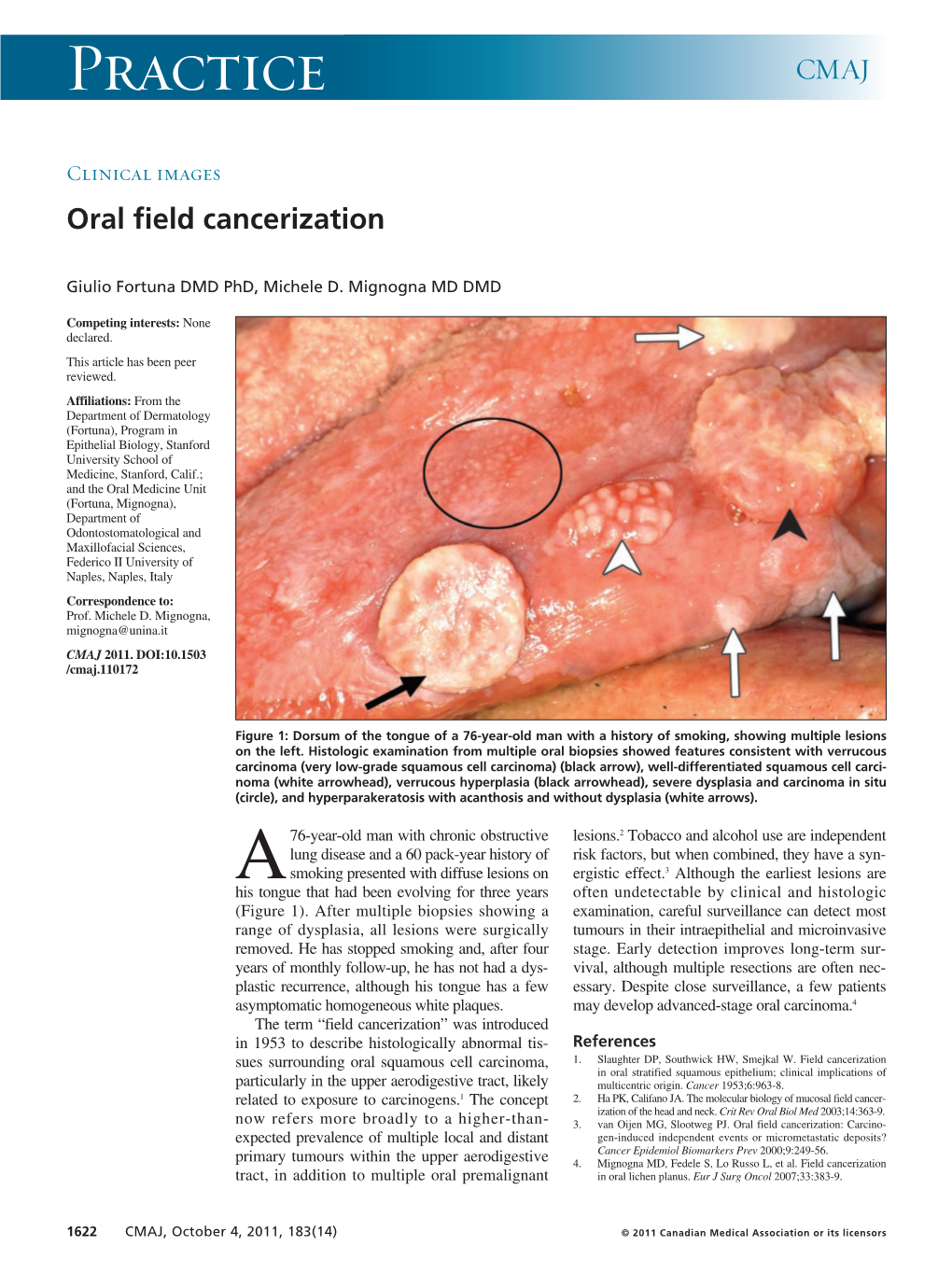 Oral Field Cancerization