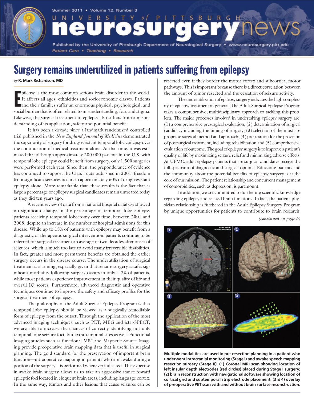 Surgery Remains Underutilized in Patients Suffering from Epilepsy by R