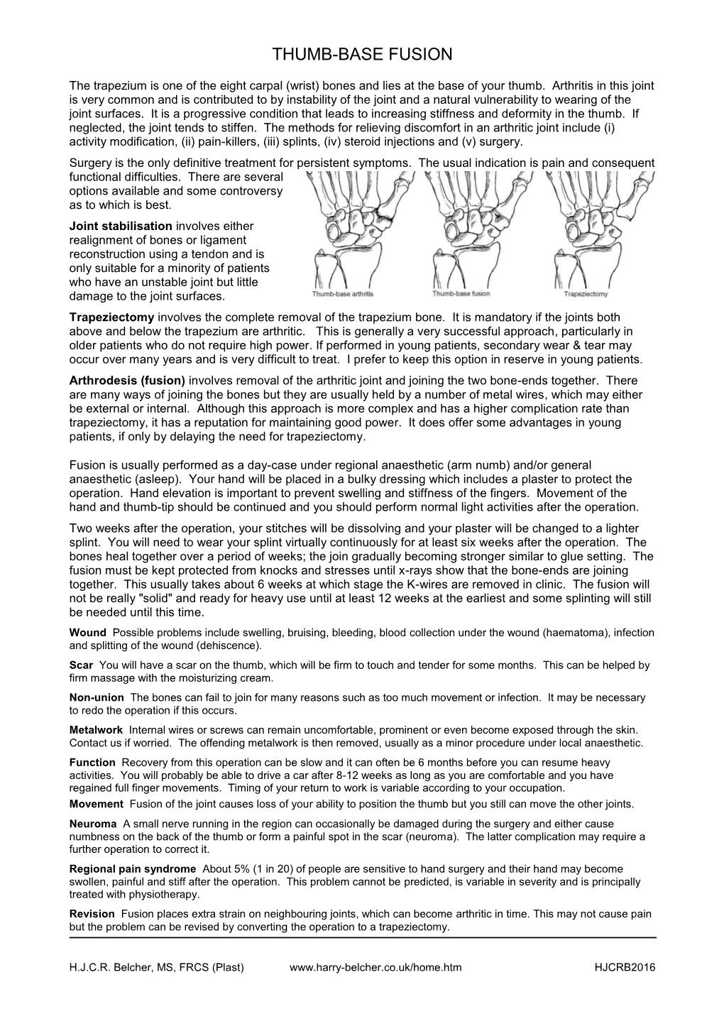 Trapezio-Metacarpal Fusion