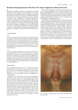 Reticulate Hyperpigmentation of the Skin After Topical Application Of