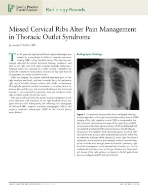 Missed Cervical Ribs Alter Pain Management in Thoracic Outlet Syndrome