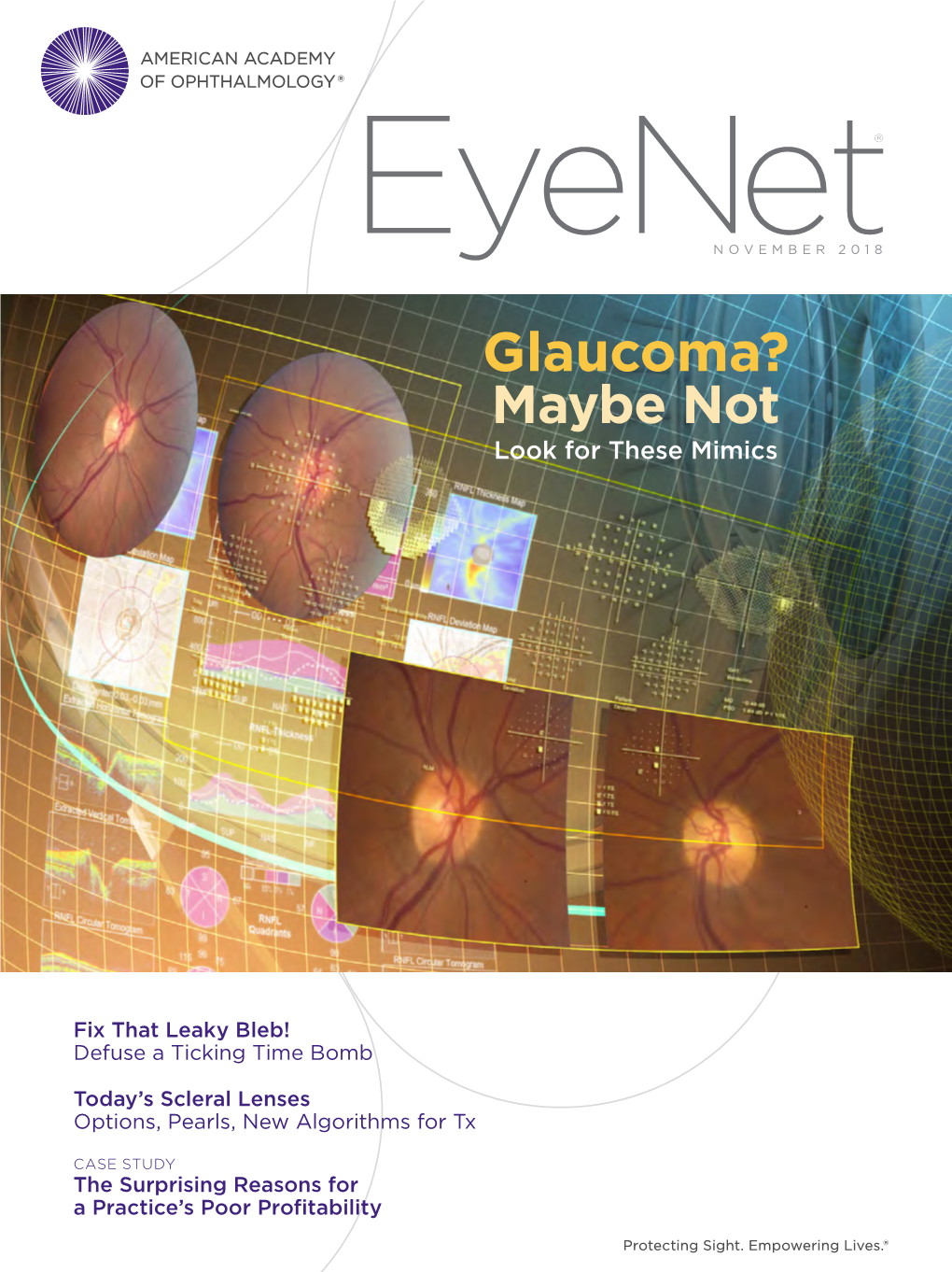 Glaucoma? Maybe Not Look for These Mimics