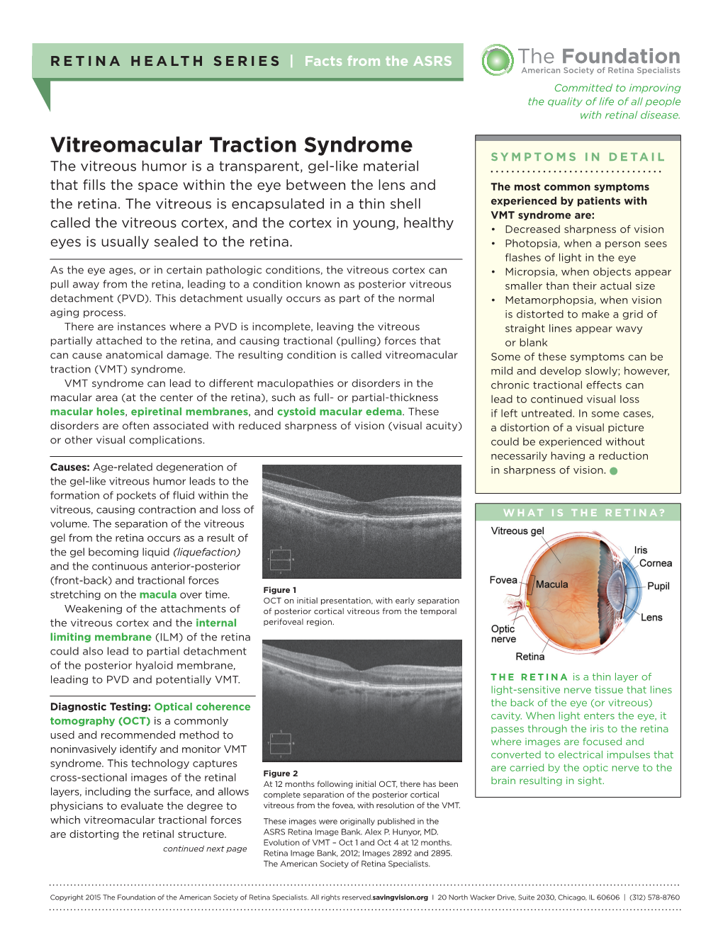 Vitreomacular Traction Syndrome