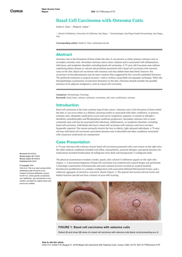 Basal Cell Carcinoma with Osteoma Cutis