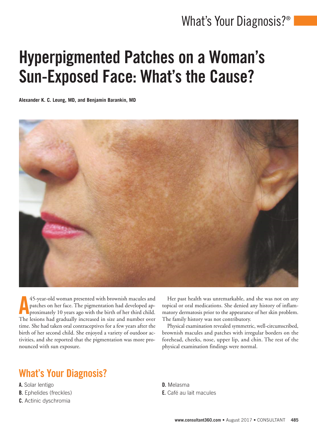 Hyperpigmented Patches on a Woman's Sun-Exposed Face