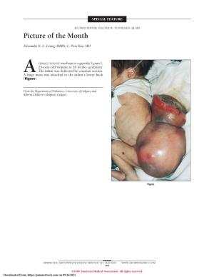 Sacrococcygeal Teratoma a Huge Sacrococcygeal Teratoma Is Attached to the Infant’S Lower Back