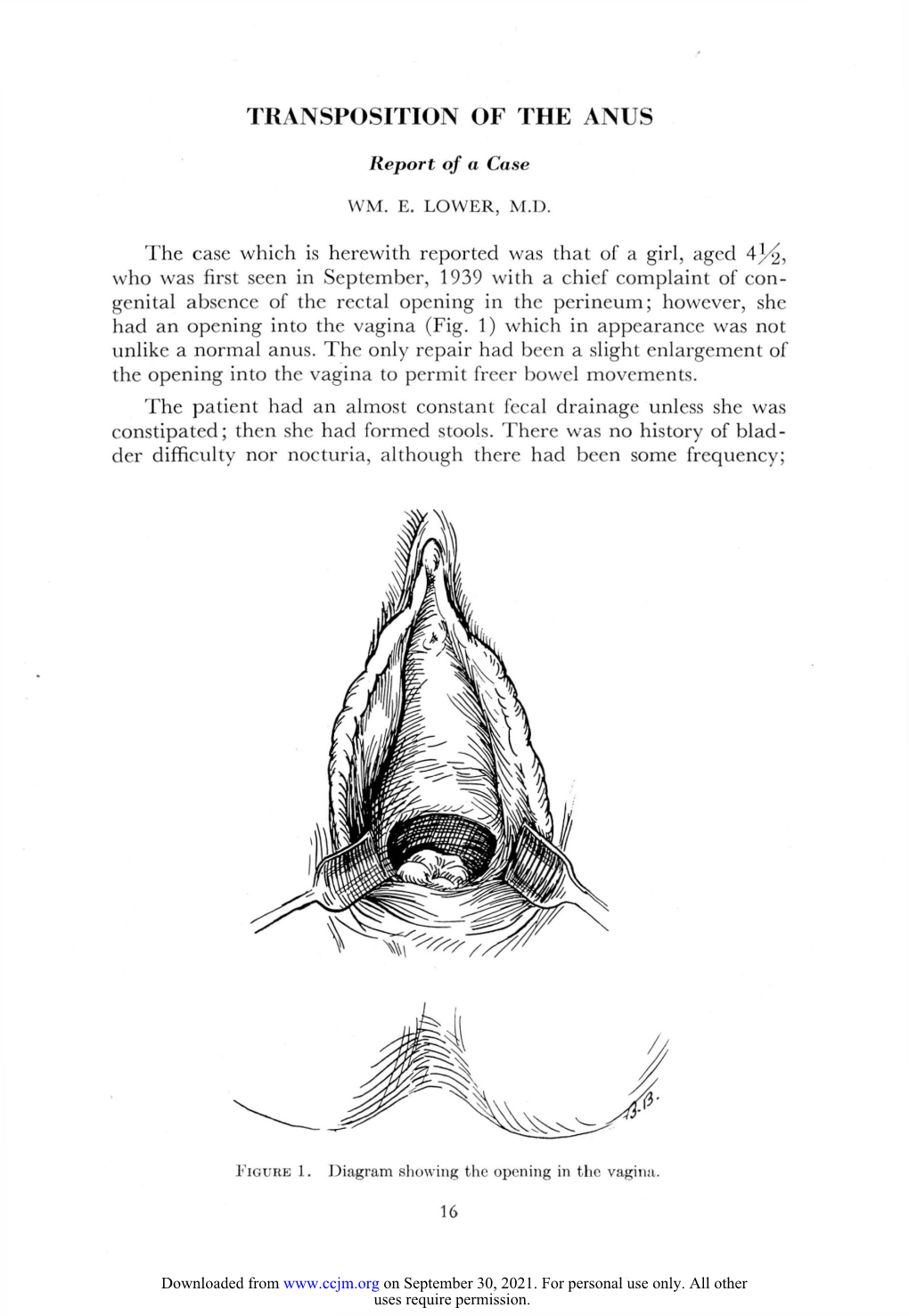 Transposition of the Anus