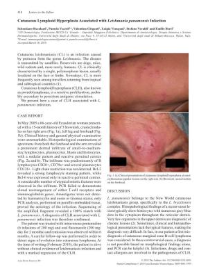 Cutaneous Lymphoid Hyperplasia Associated with Leishmania Panamensis Infection