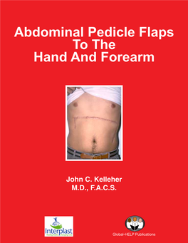 Abdominal Pedicle Flaps to the Hand & Forearm