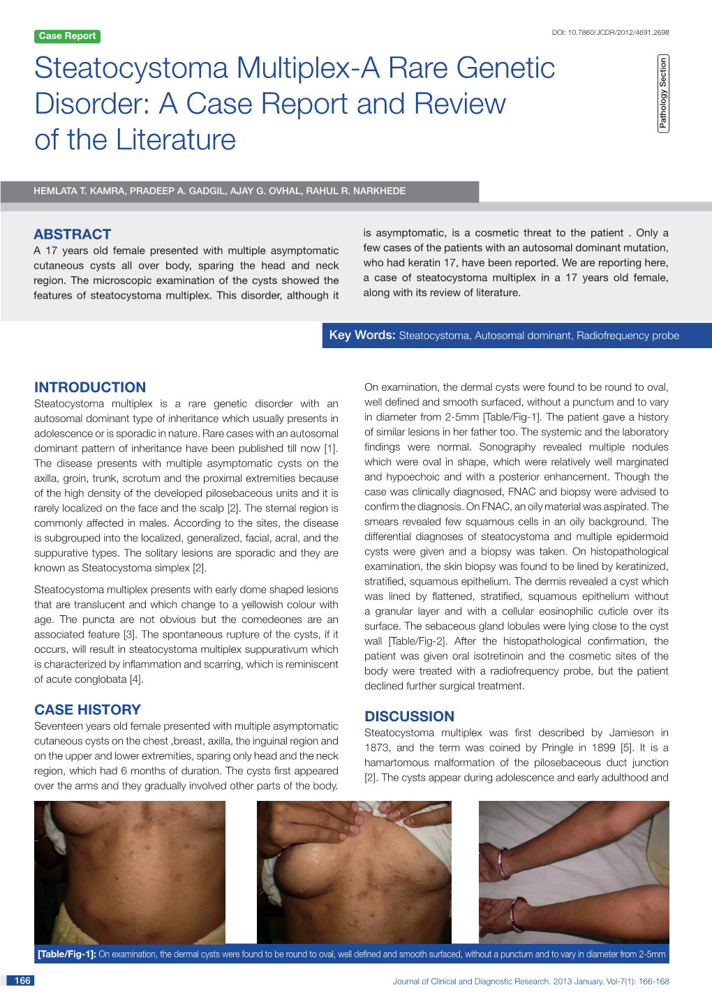 Steatocystoma Multiplex-A Rare Genetic Disorder: a Case Report and Review of the Literature Pathology Section