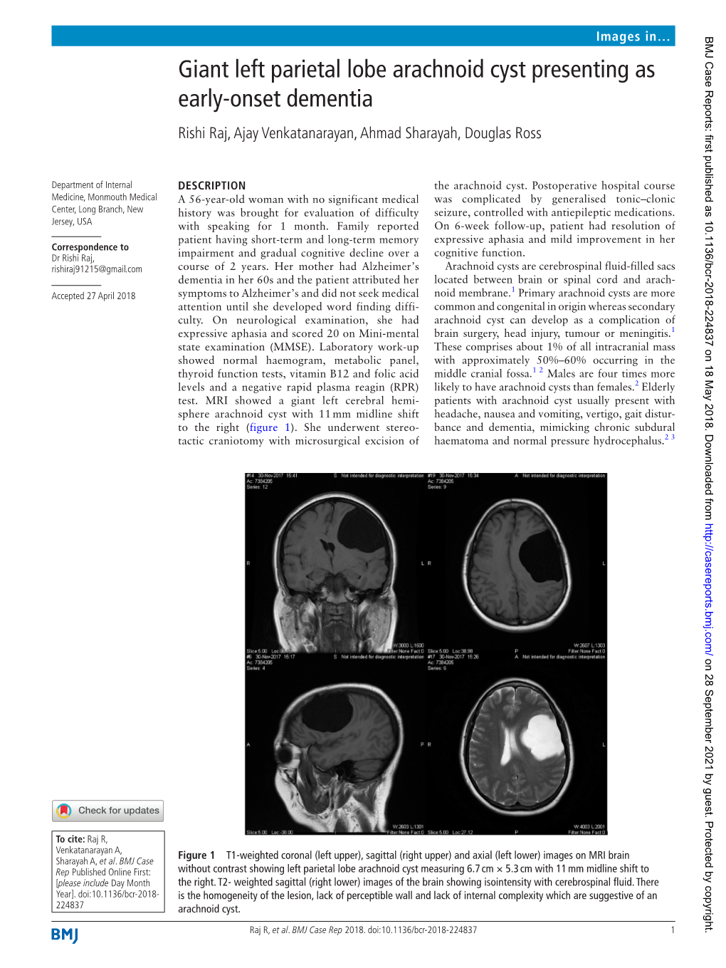 Giant Left Parietal Lobe Arachnoid Cyst Presenting As Early-Onset Dementia Rishi Raj, Ajay Venkatanarayan, Ahmad Sharayah, Douglas Ross