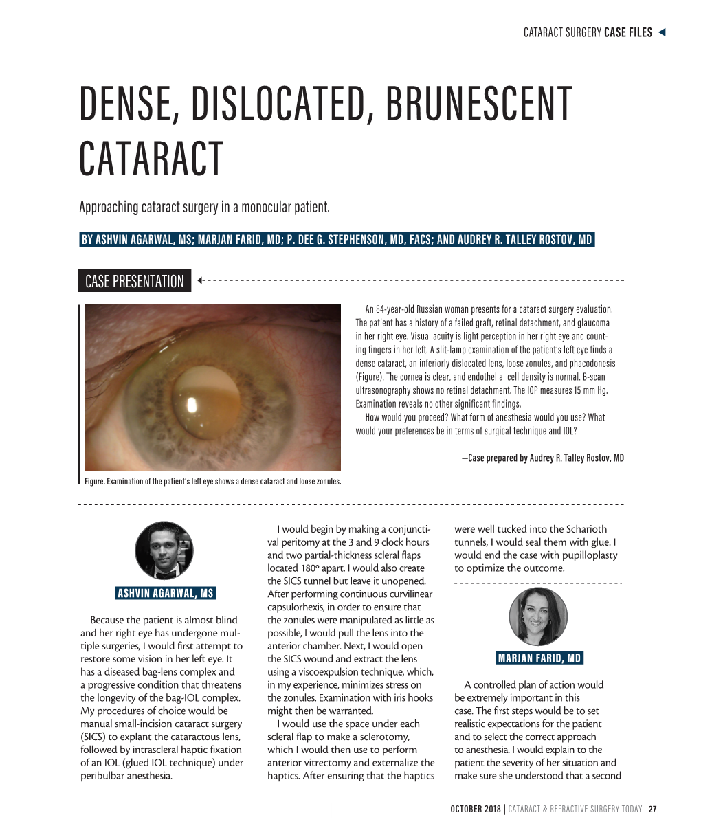 DENSE, DISLOCATED, BRUNESCENT CATARACT Approaching Cataract Surgery in a Monocular Patient