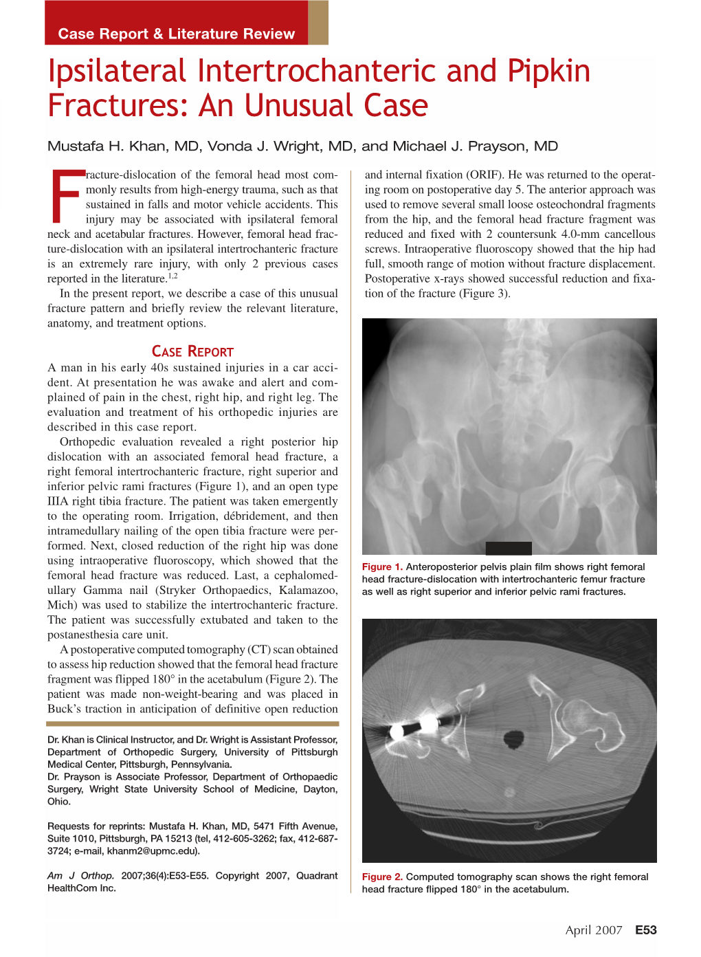 Ipsilateral Intertrochanteric and Pipkin Fractures