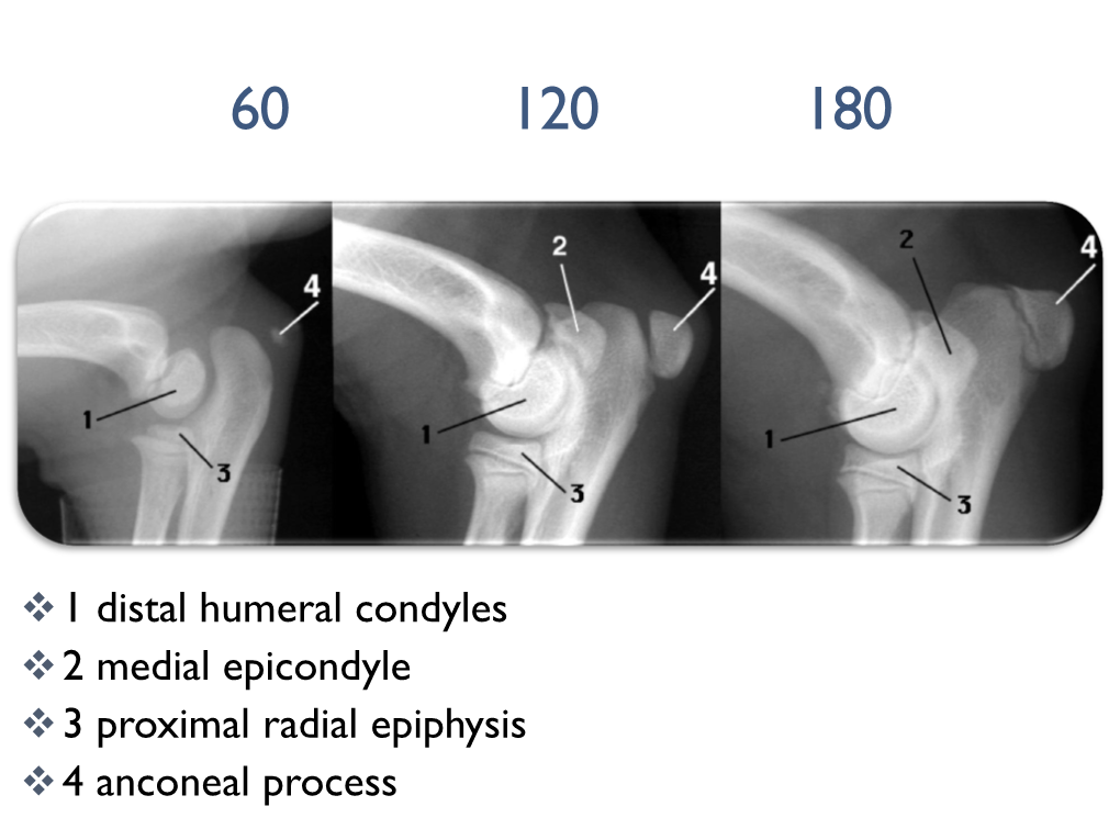 Osteochondrosis – Primary Epiphyseal (Articular/Subchondral) Lesion Can Heal Or Can Progress