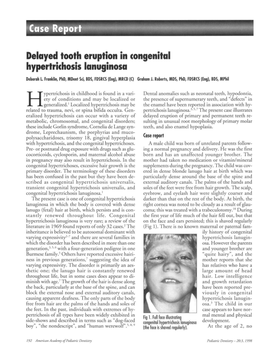 Case Report Delayed Tooth Eruption in Congenital Hypertrkhosis Lanuginosa