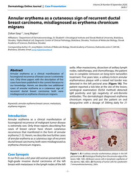 Annular Erythema As a Cutaneous Sign of Recurrent Ductal Breast Carcinoma, Misdiagnosed As Erythema Chronicum Migrans