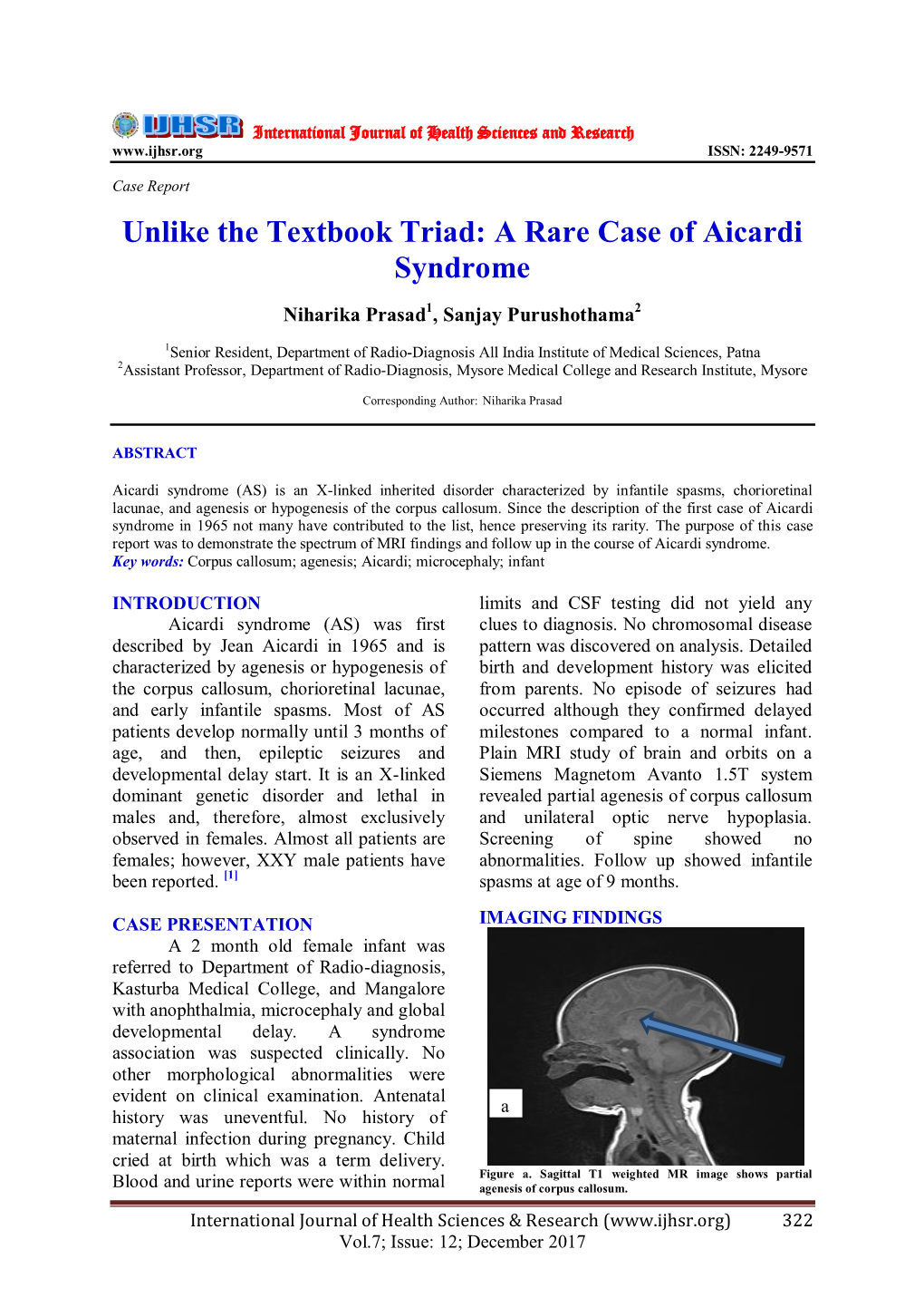 A Rare Case of Aicardi Syndrome