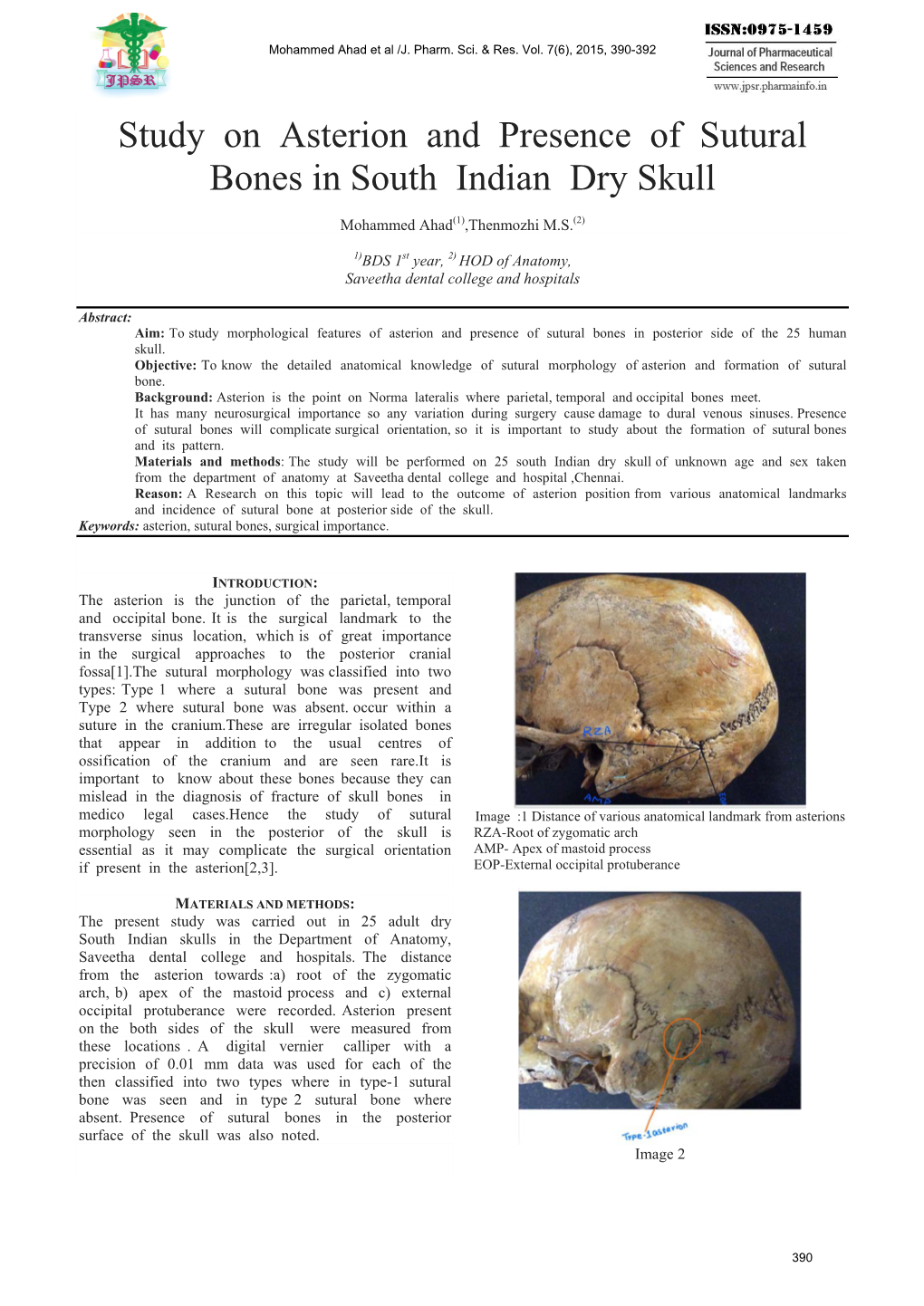 Study on Asterion and Presence of Sutural Bones in South Indian Dry Skull