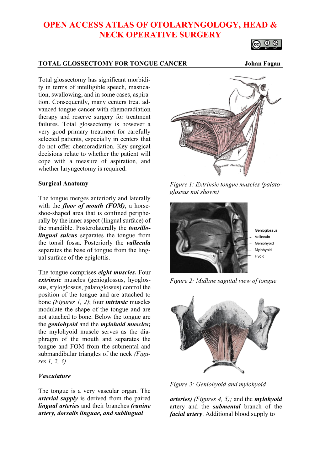 TOTAL GLOSSECTOMY for TONGUE CANCER Johan Fagan