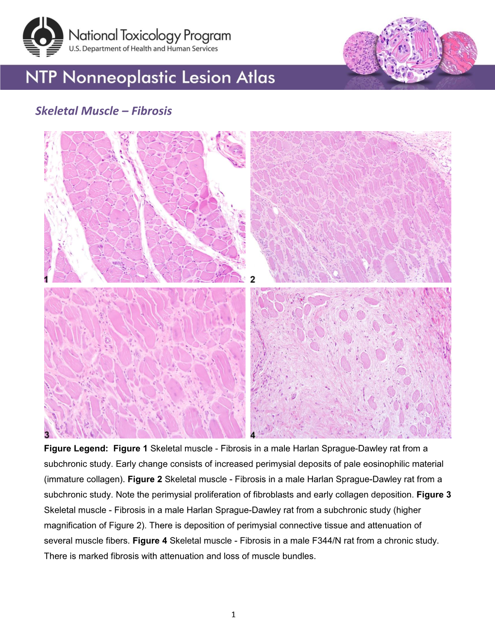 Skeletal Muscle – Fibrosis